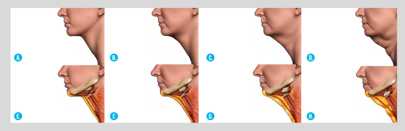 neck lift infographic