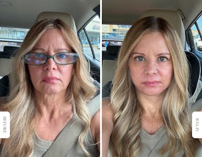 Miami Facelift/Neck Lift Before & After Gallery - Patient 339031 - Image 1 - The Chopra Plastic Surgery Center