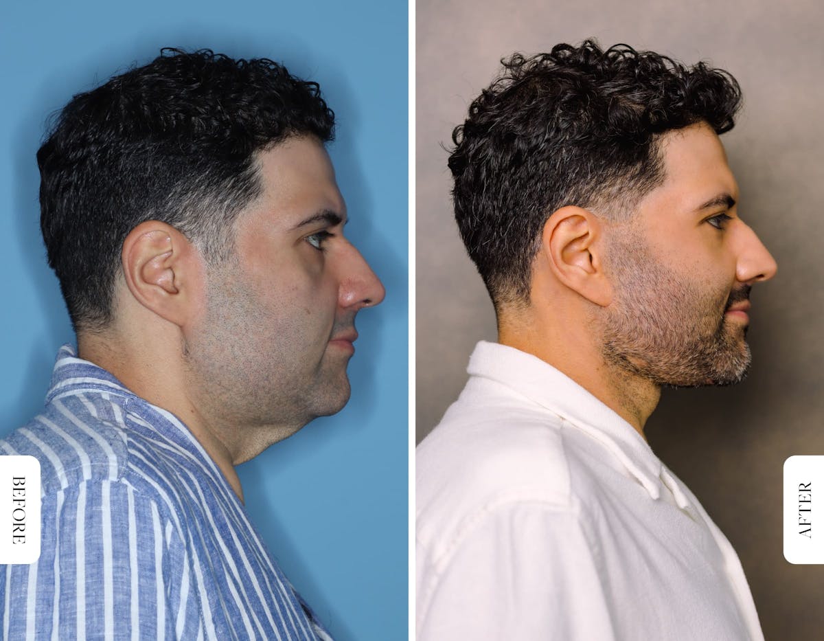 Miami Facelift/Neck Lift Before & After Gallery - Patient 392804 - Image 3 - The Chopra Plastic Surgery Center
