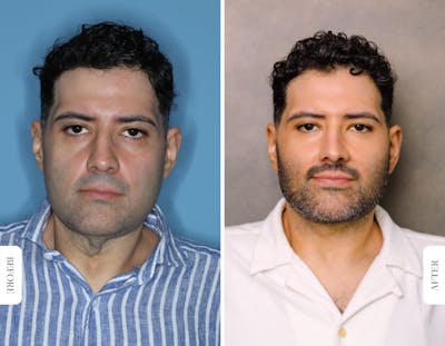 Miami Facelift/Neck Lift Before & After Gallery - Patient 392804 - Image 1 - The Chopra Plastic Surgery Center