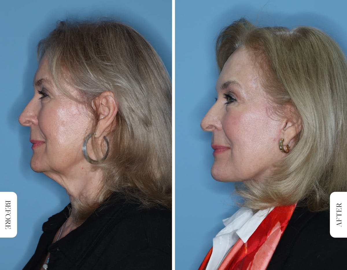 Miami Facelift/Neck Lift Before & After Gallery - Patient 173533 - Image 3 - The Chopra Plastic Surgery Center