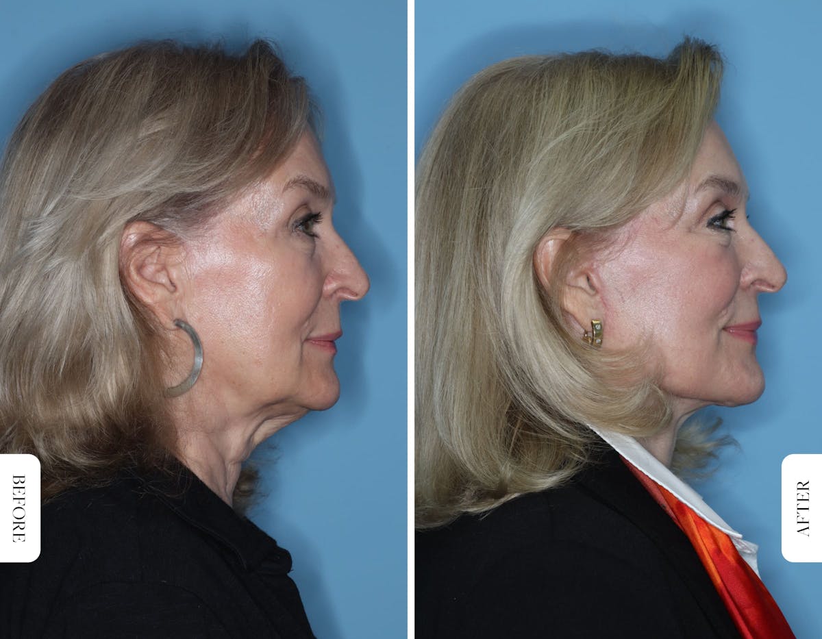 Miami Facelift/Neck Lift Before & After Gallery - Patient 173533 - Image 2 - The Chopra Plastic Surgery Center