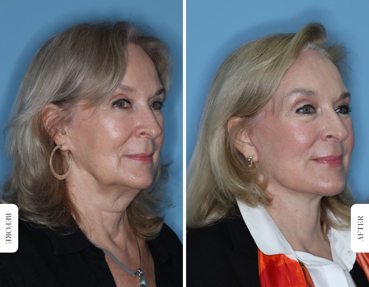 Miami Facelift/Neck Lift Before & After Gallery - Patient 173533 - Image 4 - The Chopra Plastic Surgery Center