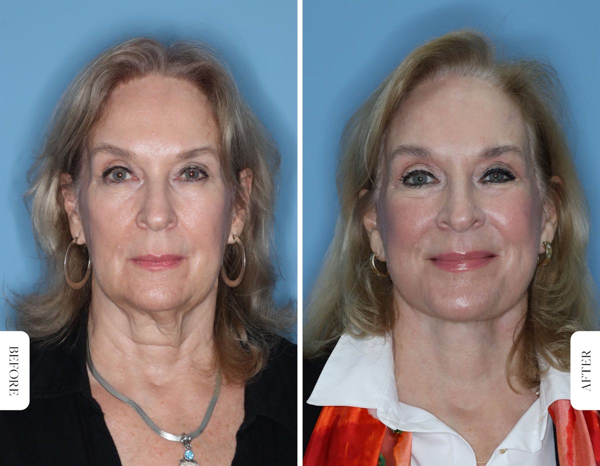 Miami Facelift/Neck Lift Before & After Gallery - Patient 173533 - Image 1 - The Chopra Plastic Surgery Center