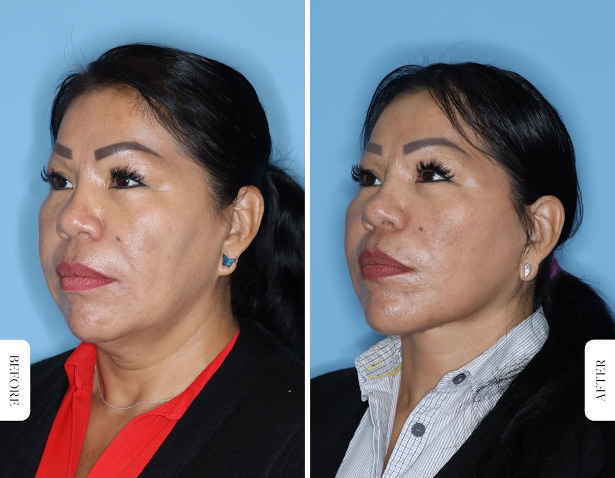 Miami Facelift/Neck Lift Before & After Gallery - Patient 681237 - Image 2 - The Chopra Plastic Surgery Center