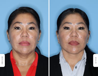 Miami Facelift/Neck Lift Before & After Gallery - Patient 681237 - Image 1 - The Chopra Plastic Surgery Center