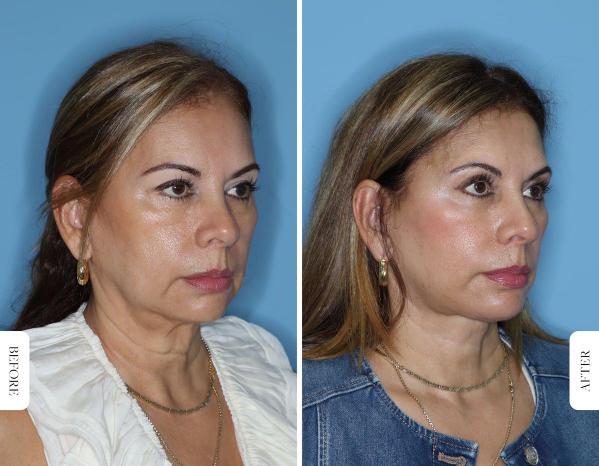 Miami Facelift/Neck Lift Before & After Gallery - Patient 217116 - Image 4 - The Chopra Plastic Surgery Center