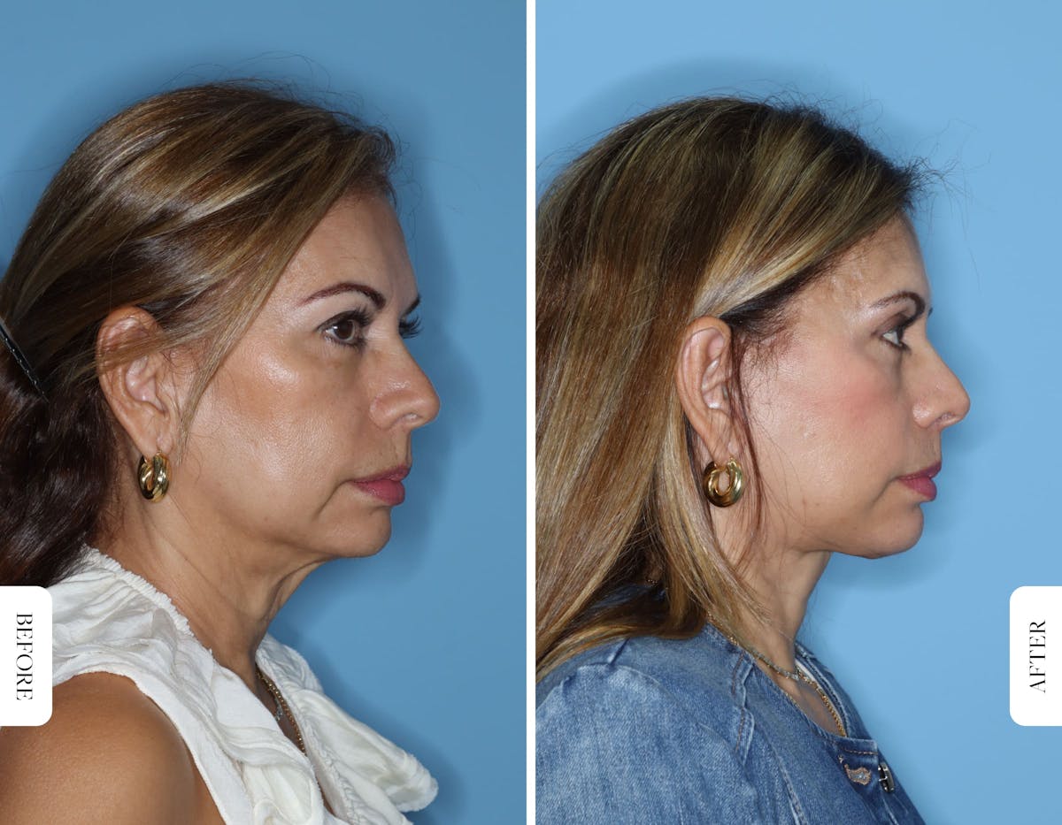 Miami Facelift/Neck Lift Before & After Gallery - Patient 217116 - Image 3 - The Chopra Plastic Surgery Center
