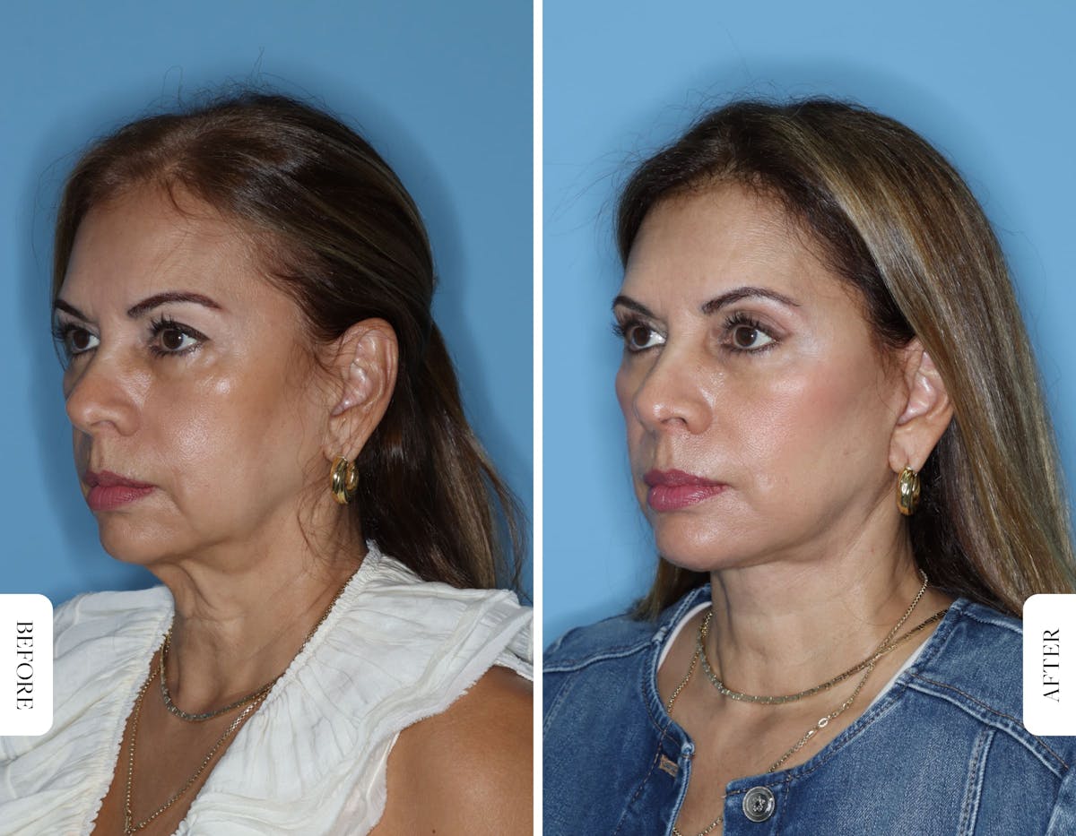 Miami Facelift/Neck Lift Before & After Gallery - Patient 217116 - Image 2 - The Chopra Plastic Surgery Center