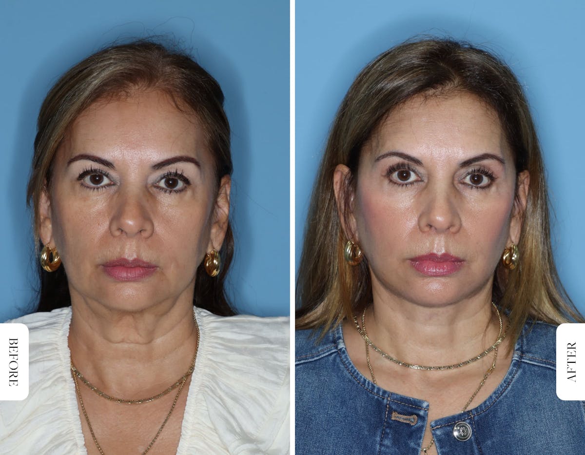 Miami Facelift/Neck Lift Before & After Gallery - Patient 217116 - Image 1 - The Chopra Plastic Surgery Center