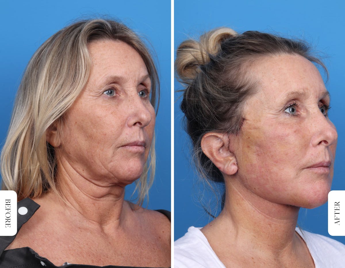 Miami Facelift/Neck Lift Before & After Gallery - Patient 160708 - Image 5 - The Chopra Plastic Surgery Center
