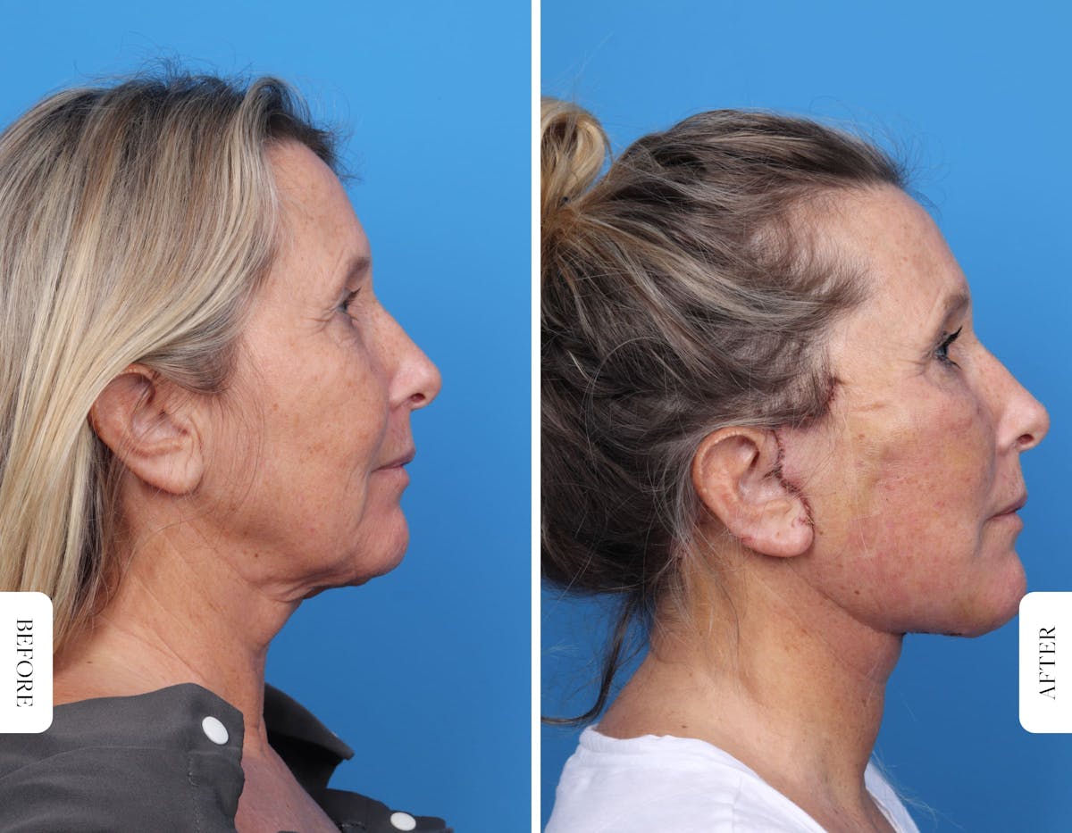 Miami Facelift/Neck Lift Before & After Gallery - Patient 160708 - Image 2 - The Chopra Plastic Surgery Center