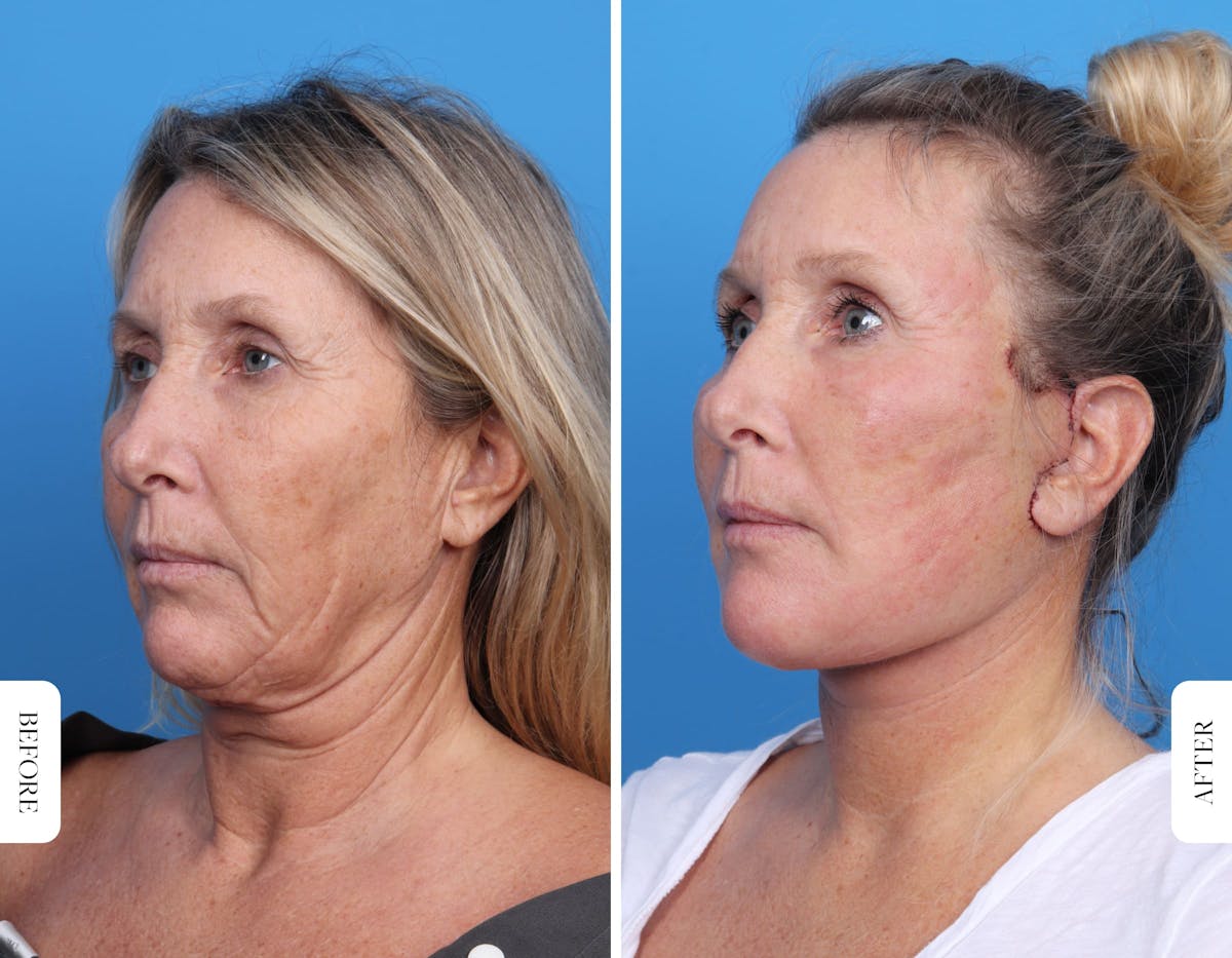 Miami Facelift/Neck Lift Before & After Gallery - Patient 160708 - Image 3 - The Chopra Plastic Surgery Center