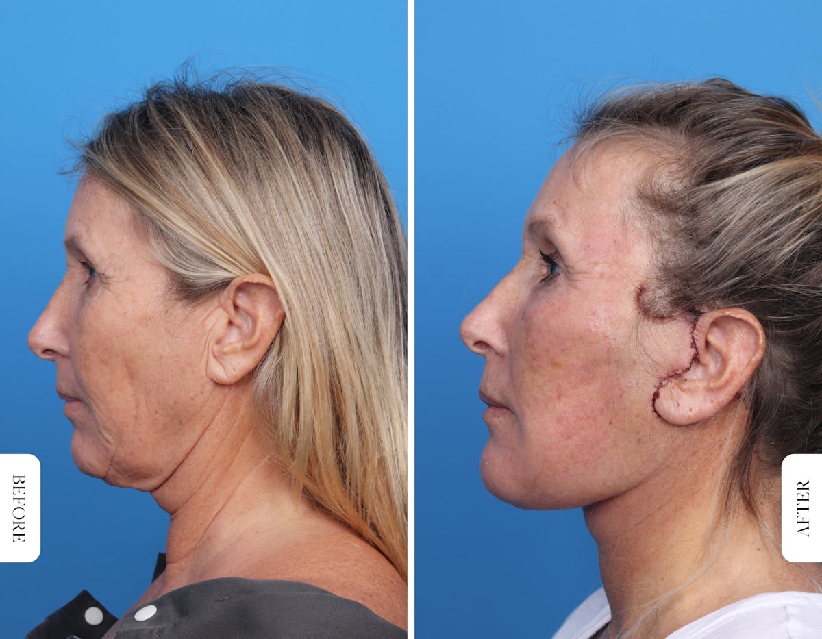 Miami Facelift/Neck Lift Before & After Gallery - Patient 160708 - Image 4 - The Chopra Plastic Surgery Center