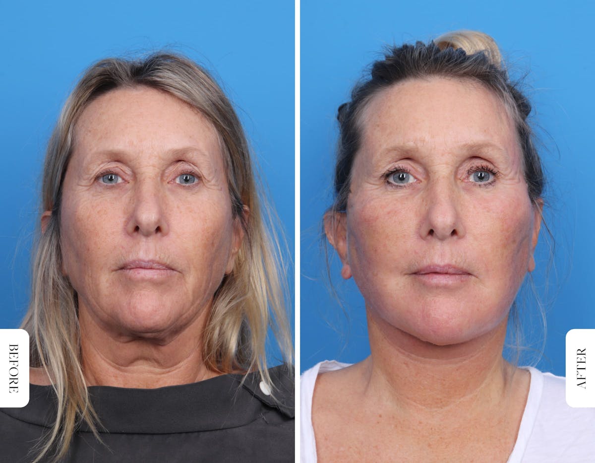 Miami Facelift/Neck Lift Before & After Gallery - Patient 160708 - Image 1 - The Chopra Plastic Surgery Center