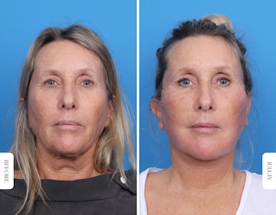 Miami Facelift/Neck Lift Before & After Gallery - Patient 160708 - Image 1 - The Chopra Plastic Surgery Center