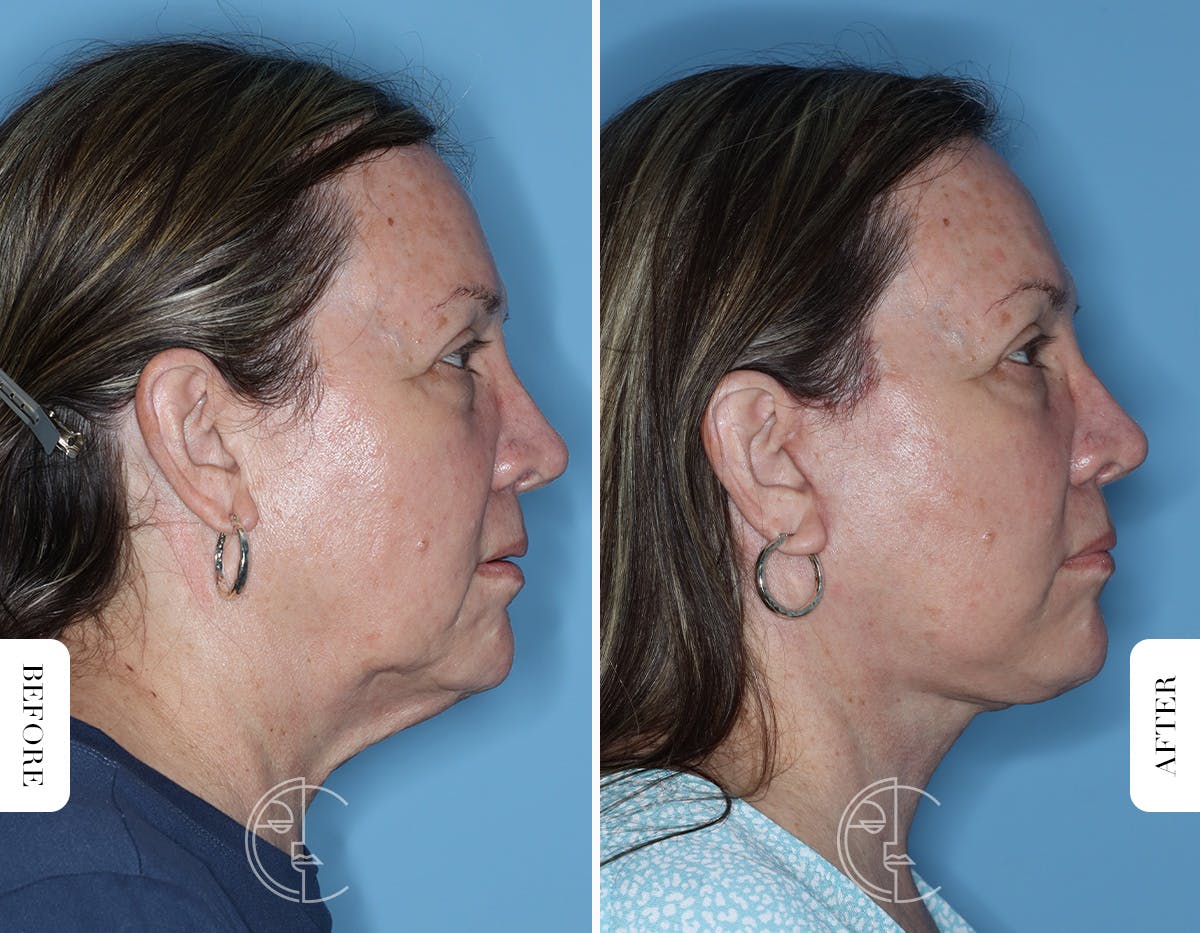 Miami Facelift/Neck Lift Before & After Gallery - Patient 122034 - Image 3 - The Chopra Plastic Surgery Center