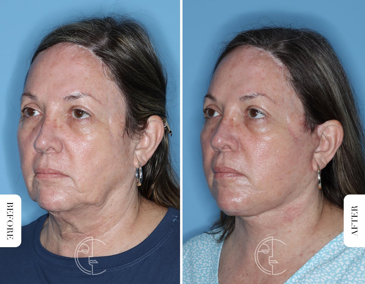Miami Facelift/Neck Lift Before & After Gallery - Patient 122034 - Image 4 - The Chopra Plastic Surgery Center