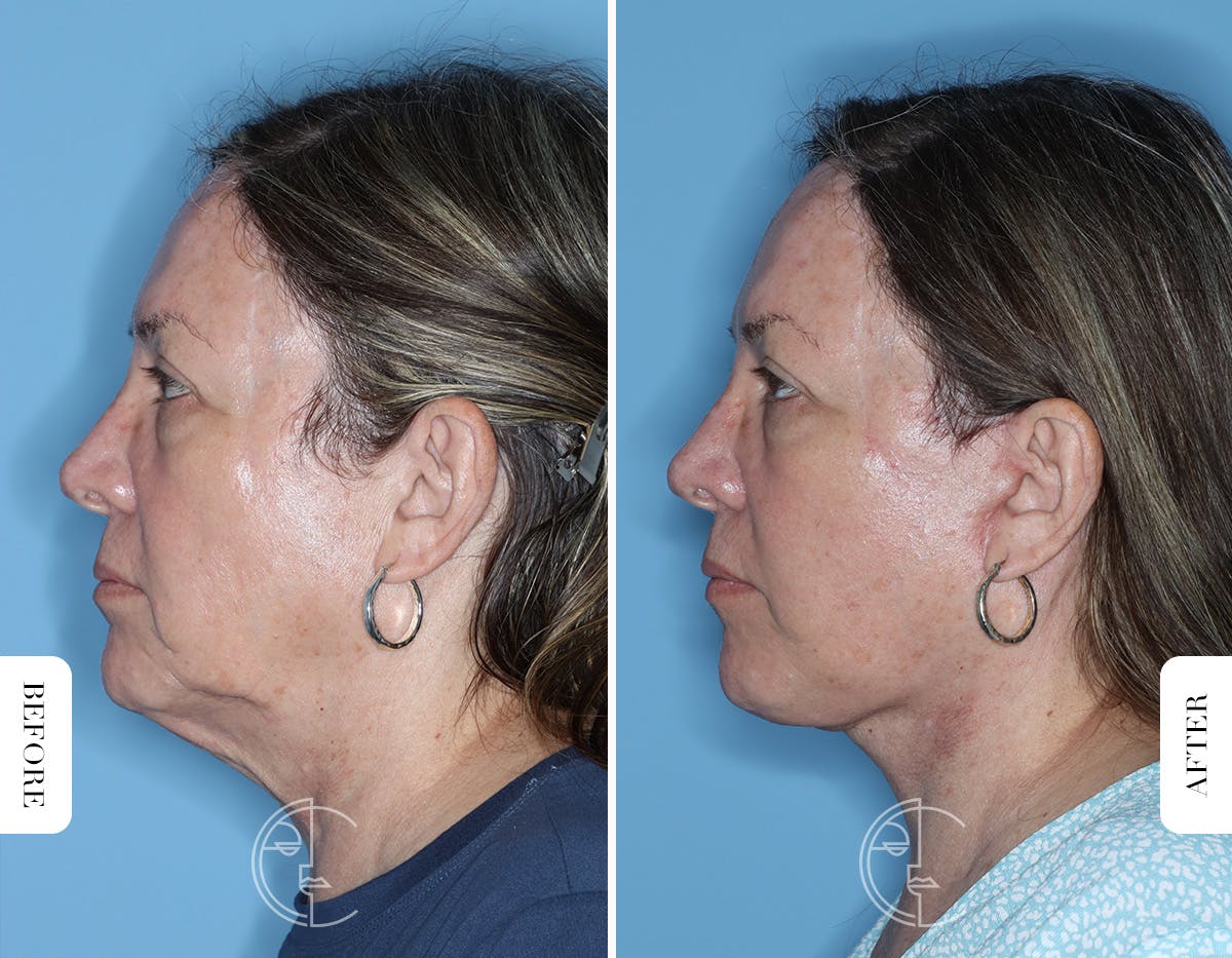 Miami Facelift/Neck Lift Before & After Gallery - Patient 122034 - Image 5 - The Chopra Plastic Surgery Center