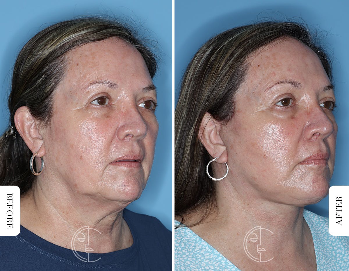 Miami Facelift/Neck Lift Before & After Gallery - Patient 122034 - Image 2 - The Chopra Plastic Surgery Center