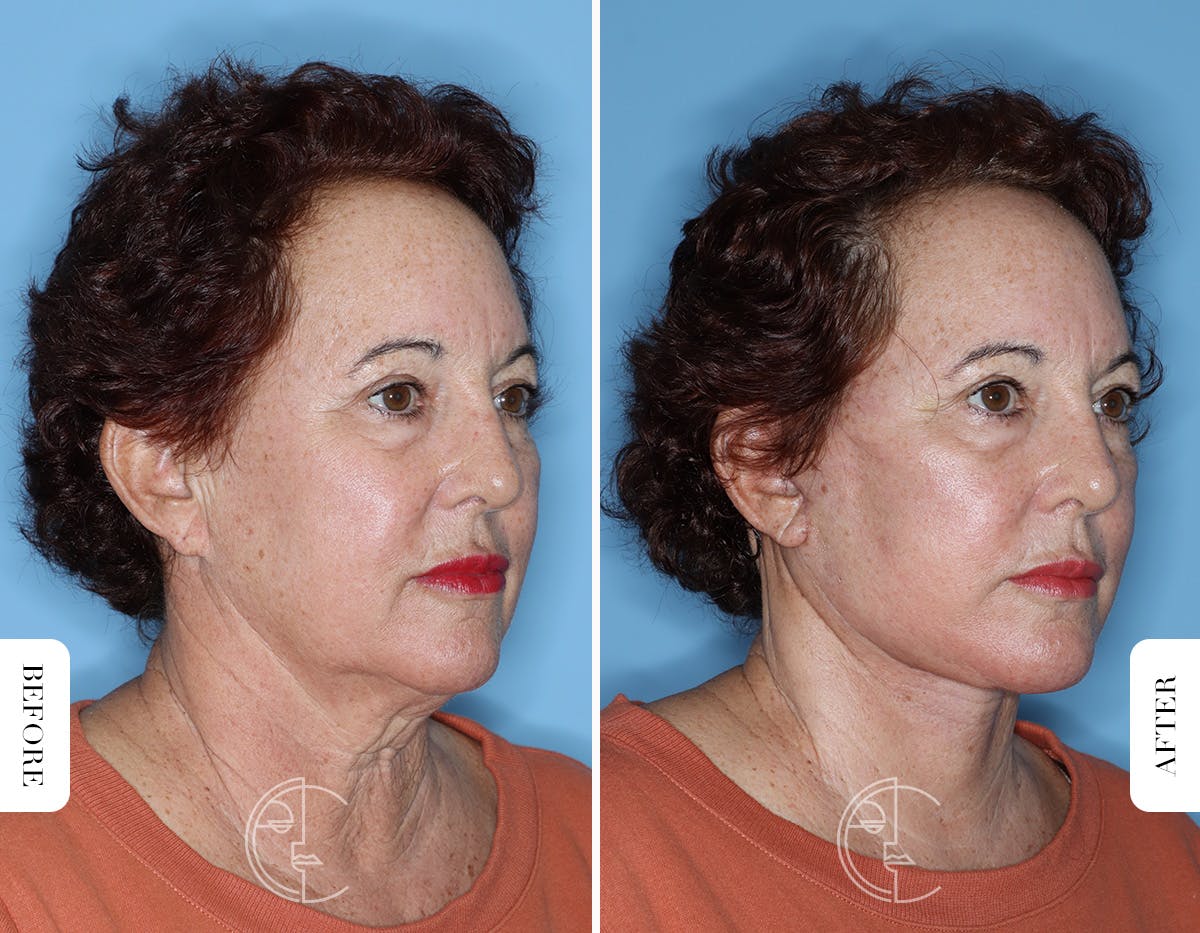 Miami Facelift/Neck Lift Before & After Gallery - Patient 281990 - Image 2 - The Chopra Plastic Surgery Center