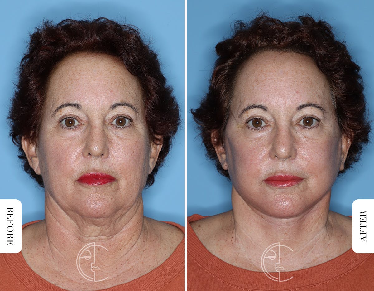 Miami Facelift/Neck Lift Before & After Gallery - Patient 281990 - Image 1 - The Chopra Plastic Surgery Center