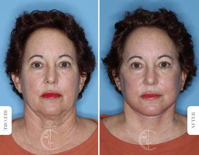 Miami Facelift/Neck Lift Before & After Gallery - Patient 281990 - Image 1 - The Chopra Plastic Surgery Center
