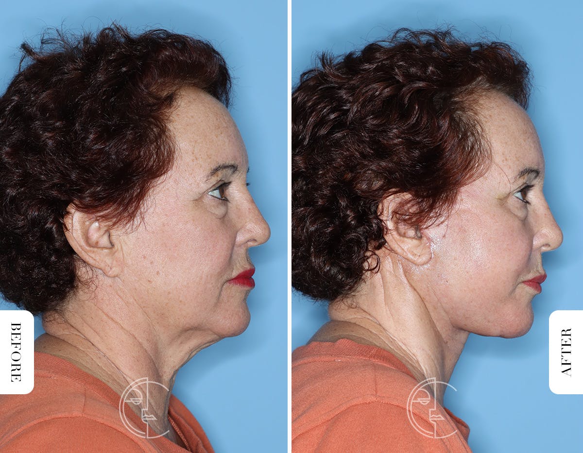 Miami Facelift/Neck Lift Before & After Gallery - Patient 281990 - Image 3 - The Chopra Plastic Surgery Center