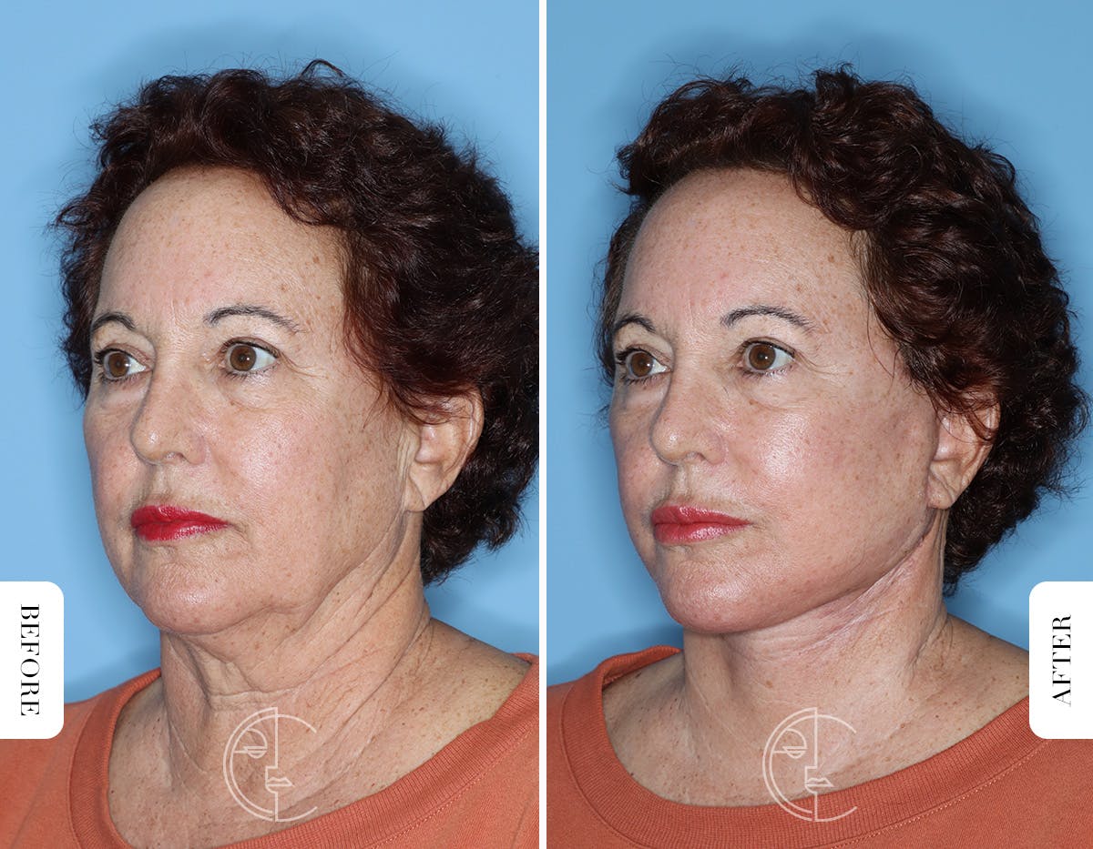 Miami Facelift/Neck Lift Before & After Gallery - Patient 281990 - Image 4 - The Chopra Plastic Surgery Center