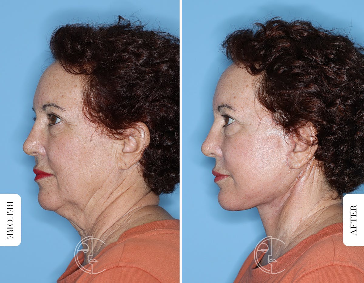 Miami Facelift/Neck Lift Before & After Gallery - Patient 281990 - Image 5 - The Chopra Plastic Surgery Center