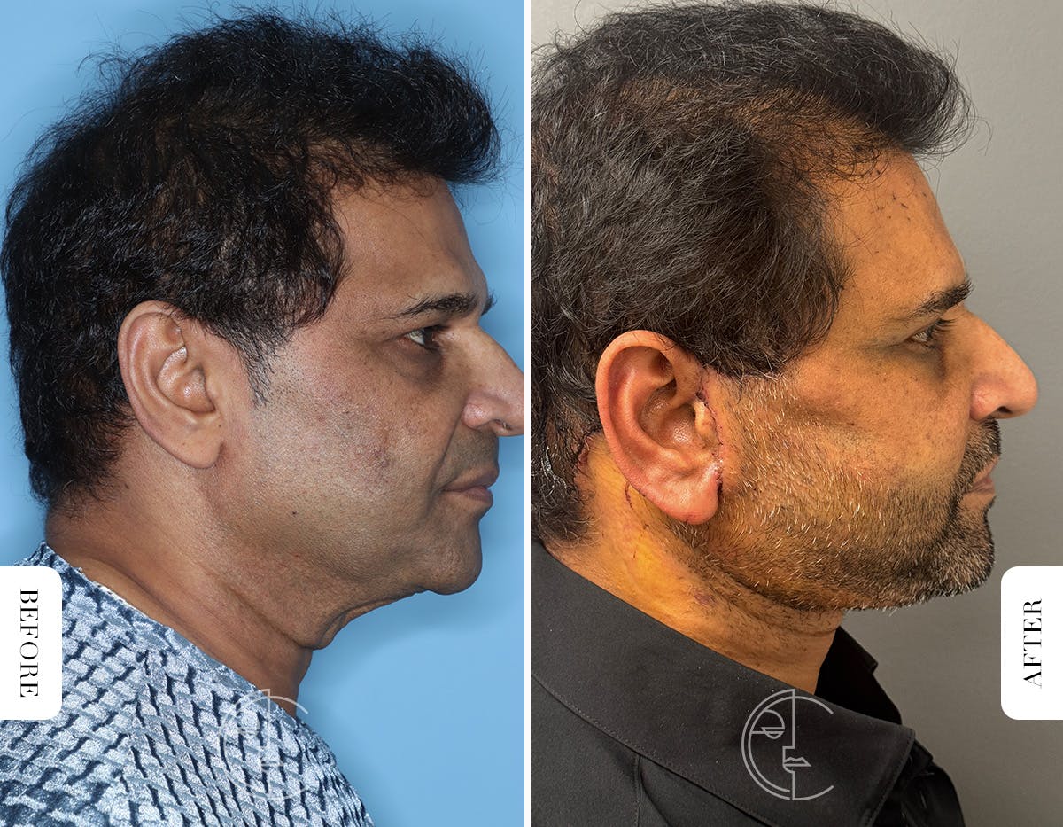 Miami Male Facelift & Neck Lift Before & After Gallery - Patient 180644 - Image 2 - The Chopra Plastic Surgery Center