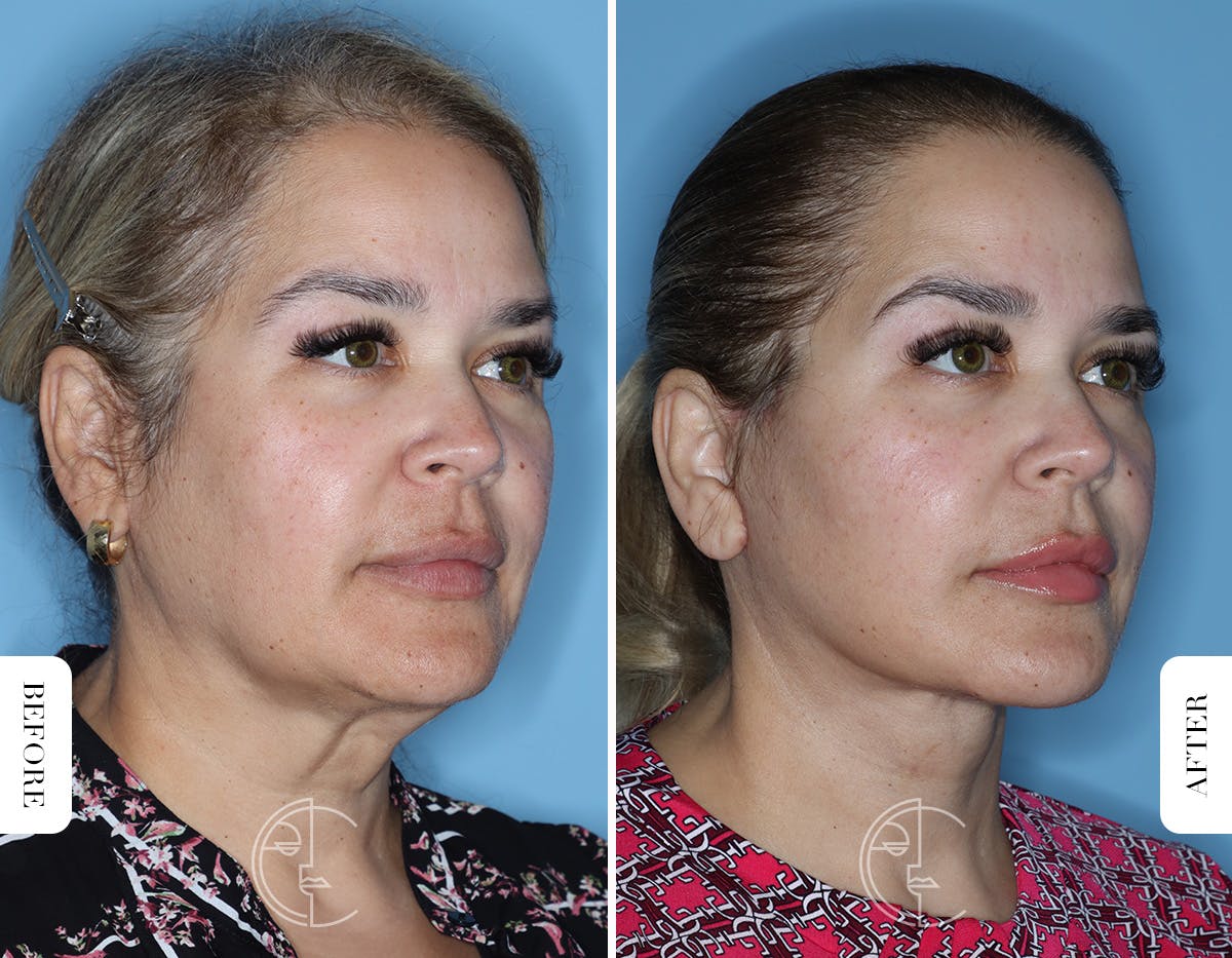 Miami Facelift/Neck Lift Before & After Gallery - Patient 754729 - Image 2 - The Chopra Plastic Surgery Center