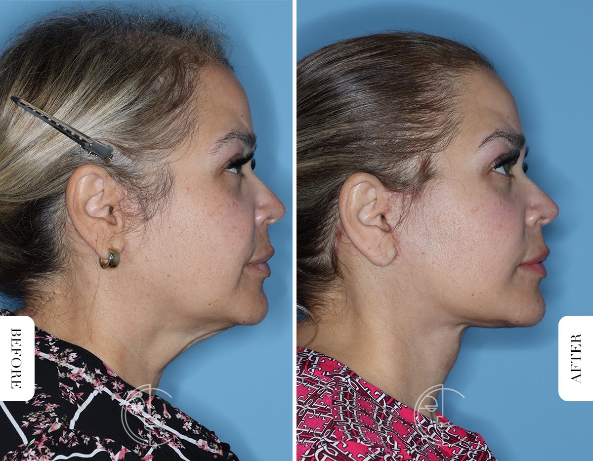 Miami Facelift/Neck Lift Before & After Gallery - Patient 754729 - Image 3 - The Chopra Plastic Surgery Center