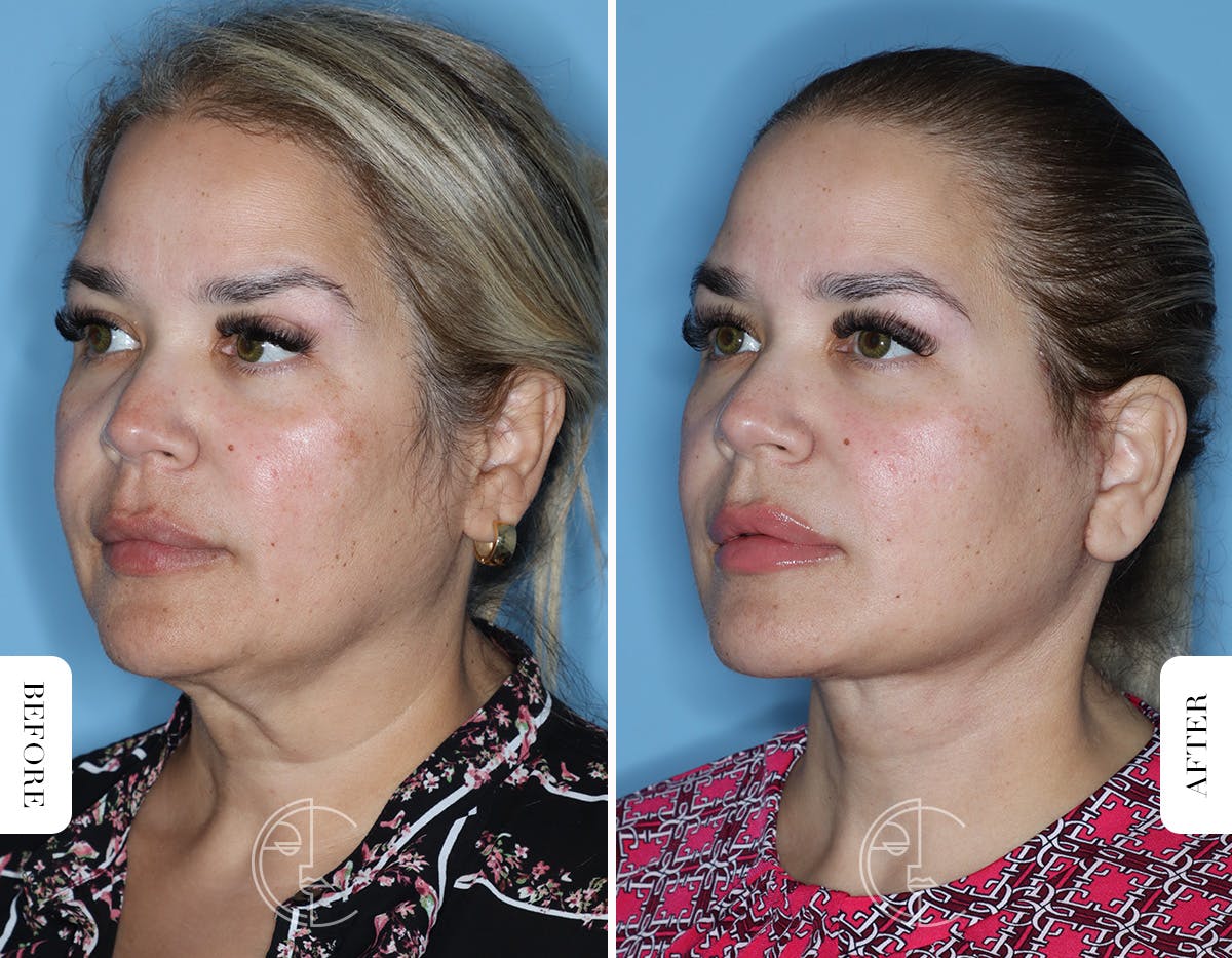 Miami Facelift/Neck Lift Before & After Gallery - Patient 754729 - Image 4 - The Chopra Plastic Surgery Center