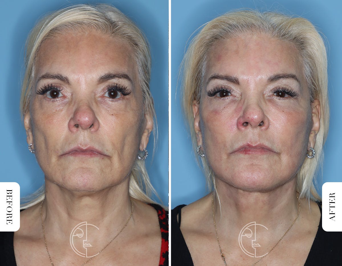 Miami Revision Facelift & Neck Lift Before & After Gallery - Patient 171962 - Image 1 - The Chopra Plastic Surgery Center