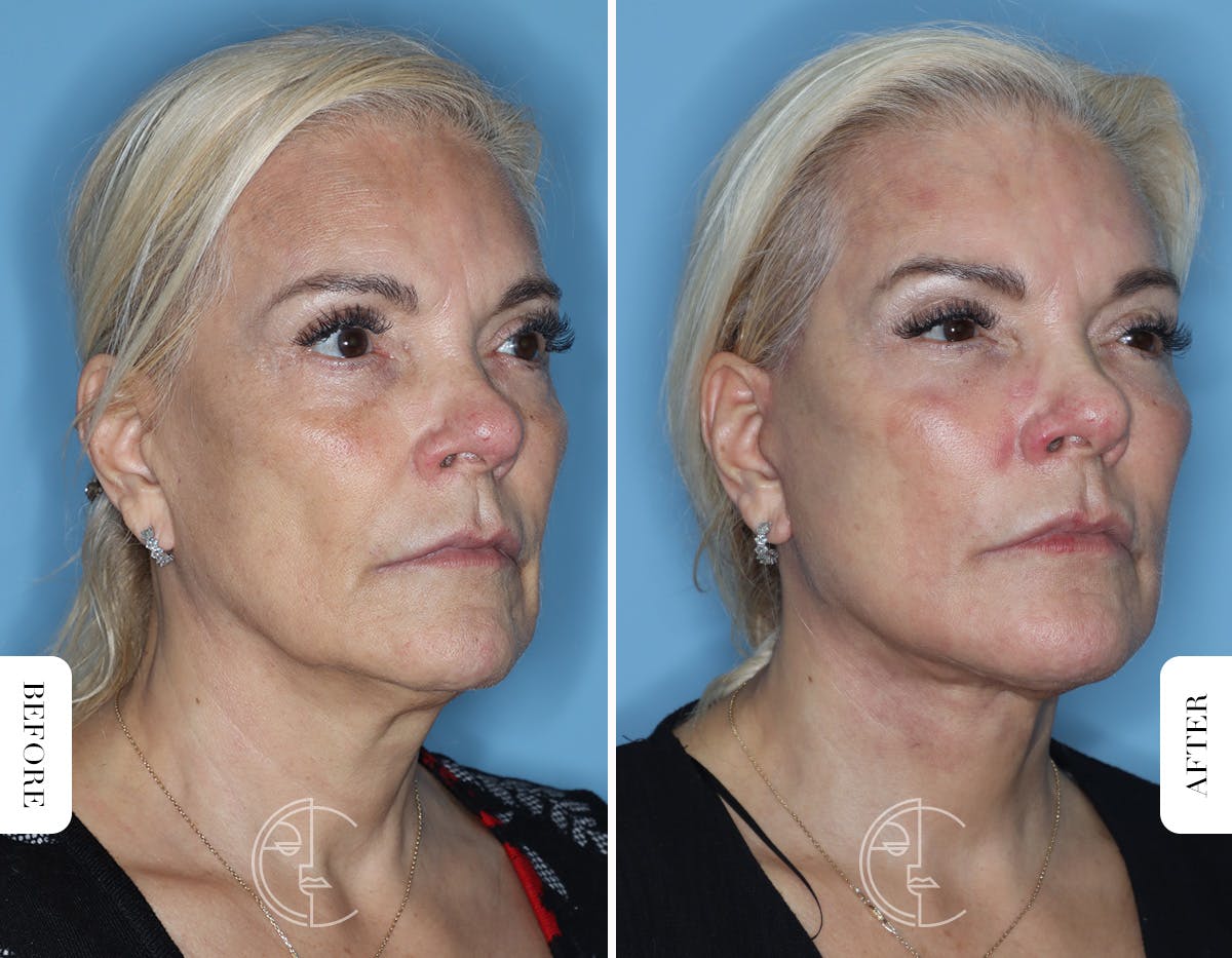 Miami Revision Facelift & Neck Lift Before & After Gallery - Patient 171962 - Image 2 - The Chopra Plastic Surgery Center