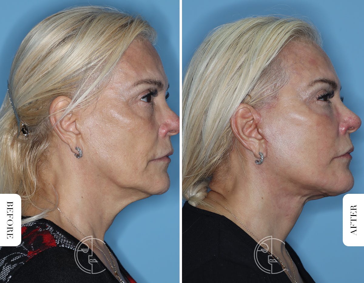 Miami Revision Facelift & Neck Lift Before & After Gallery - Patient 171962 - Image 3 - The Chopra Plastic Surgery Center