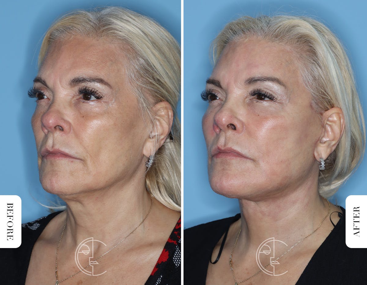 Miami Revision Facelift & Neck Lift Before & After Gallery - Patient 171962 - Image 4 - The Chopra Plastic Surgery Center
