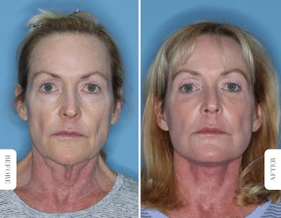 Miami Facelift/Neck Lift Before & After Gallery - Patient 380396 - Image 1 - The Chopra Plastic Surgery Center