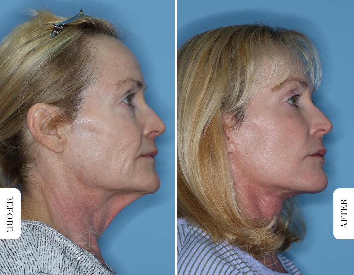 Miami Laser Resurfacing Before & After Gallery - Patient 244971 - Image 3 - The Chopra Plastic Surgery Center