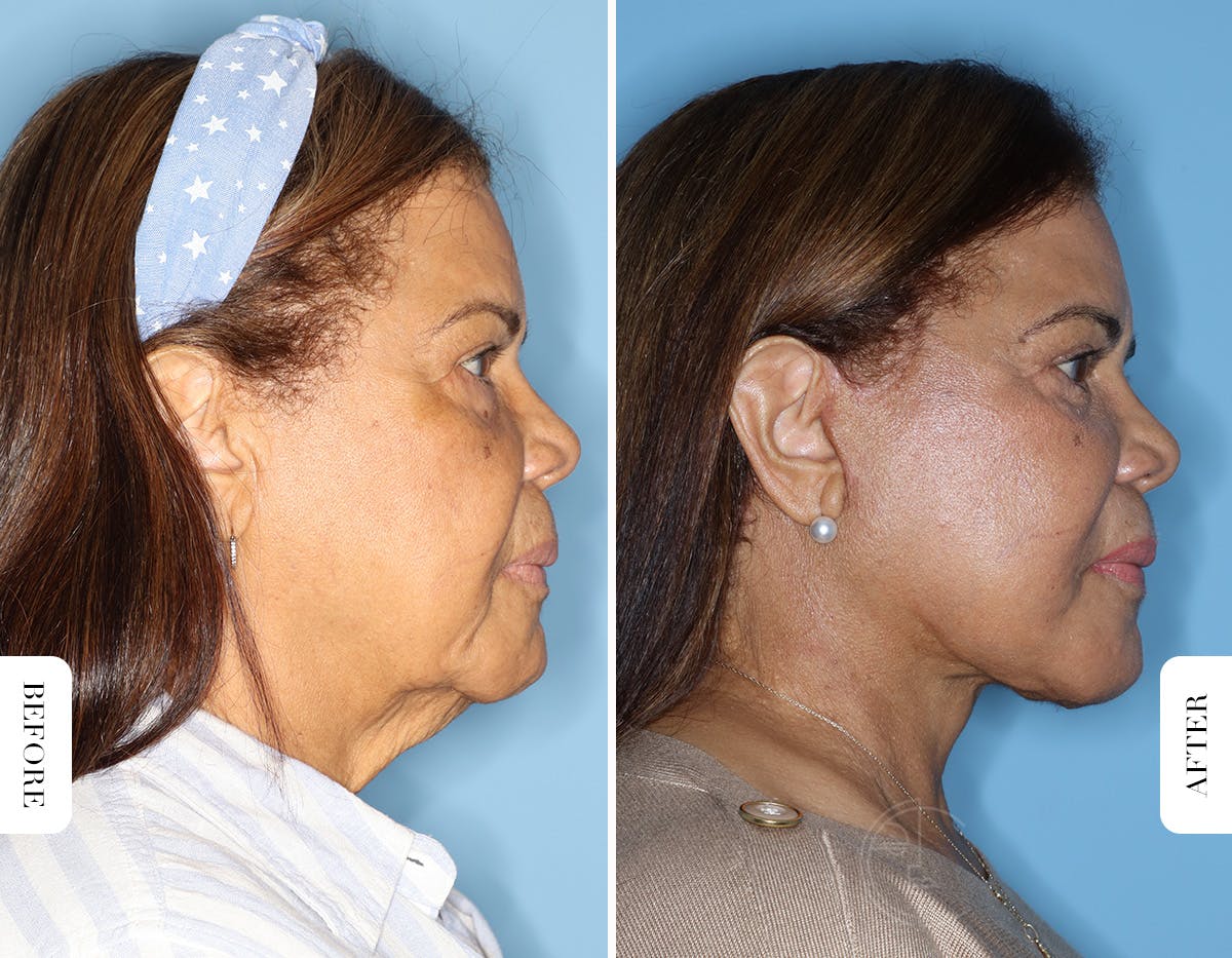 Miami Facelift/Neck Lift Before & After Gallery - Patient 508987 - Image 3 - The Chopra Plastic Surgery Center