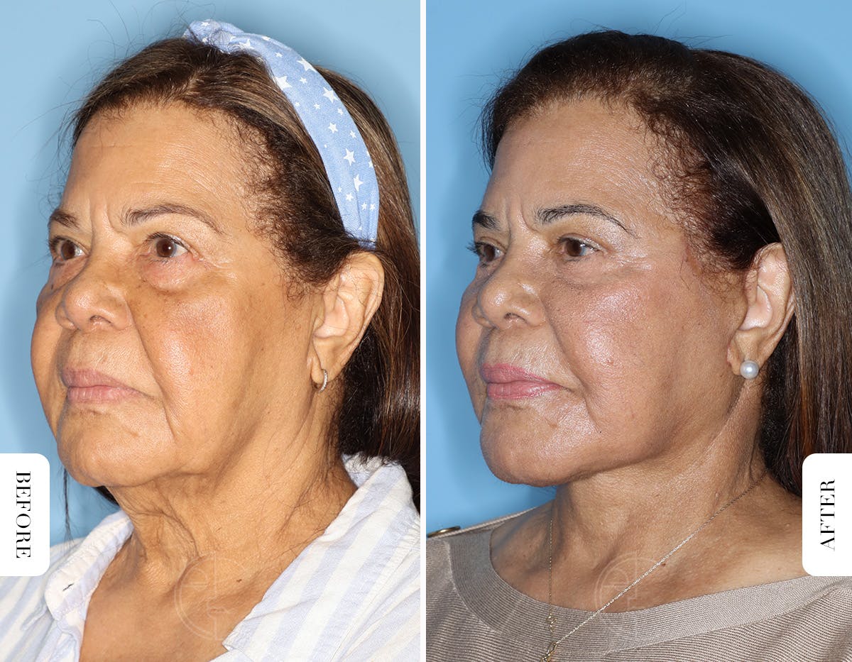 Miami Facelift/Neck Lift Before & After Gallery - Patient 508987 - Image 4 - The Chopra Plastic Surgery Center