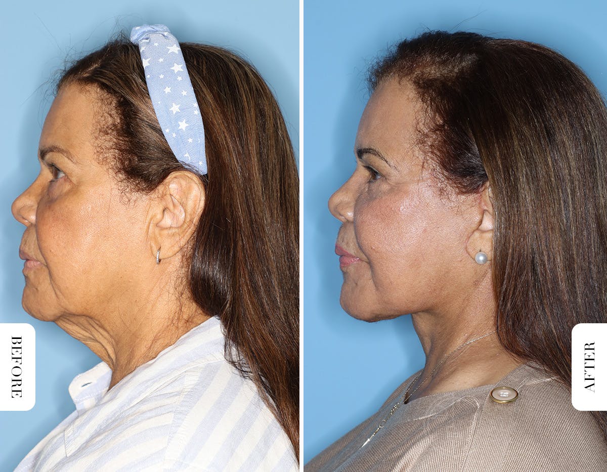 Miami Facelift/Neck Lift Before & After Gallery - Patient 508987 - Image 5 - The Chopra Plastic Surgery Center