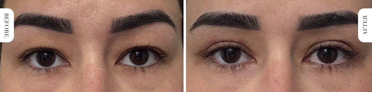 Miami Upper Eyelid Lift Before & After Gallery - Patient 807853 - Image 1 - The Chopra Plastic Surgery Center