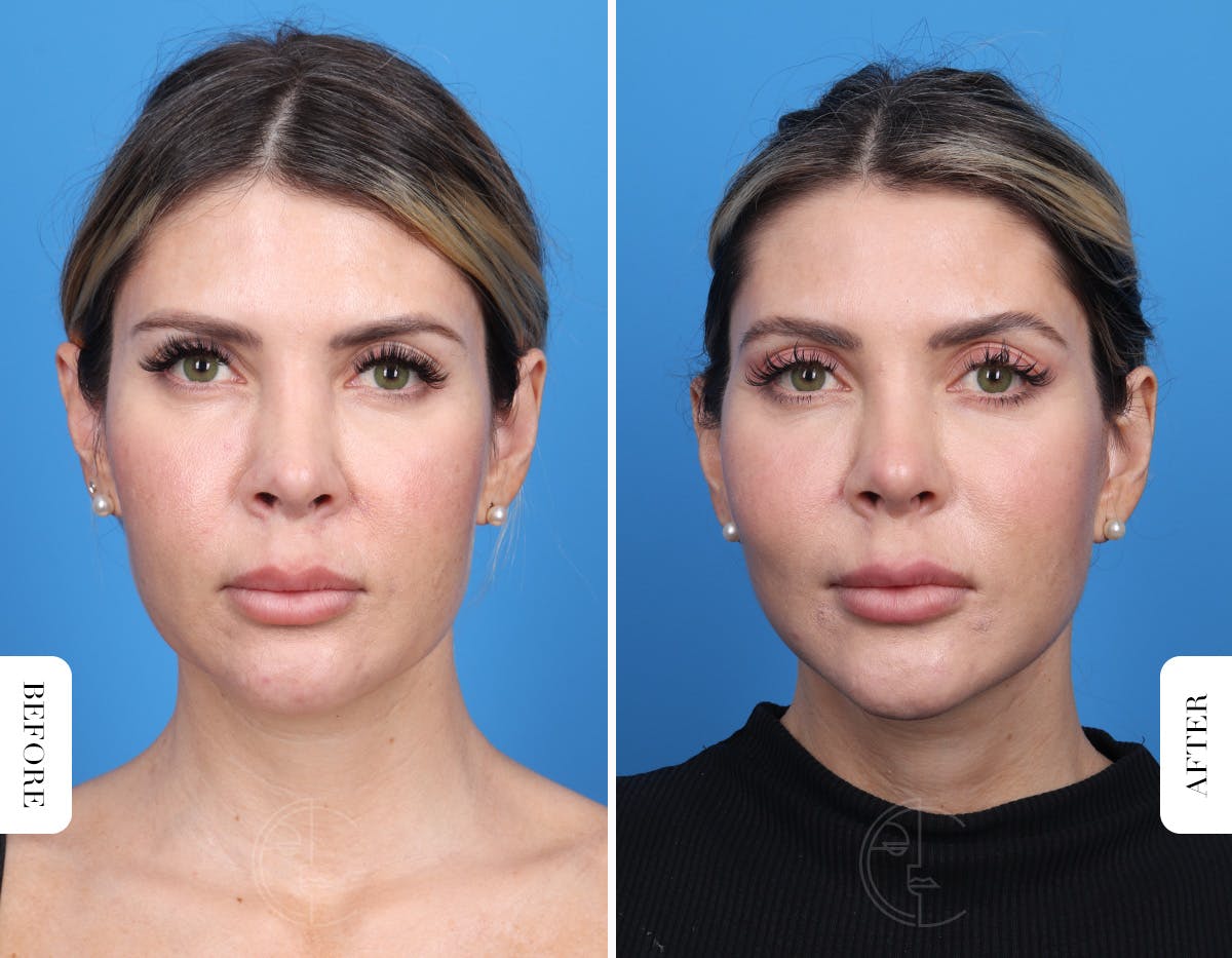 Miami Facelift/Neck Lift Before & After Gallery - Patient 294573 - Image 1 - The Chopra Plastic Surgery Center