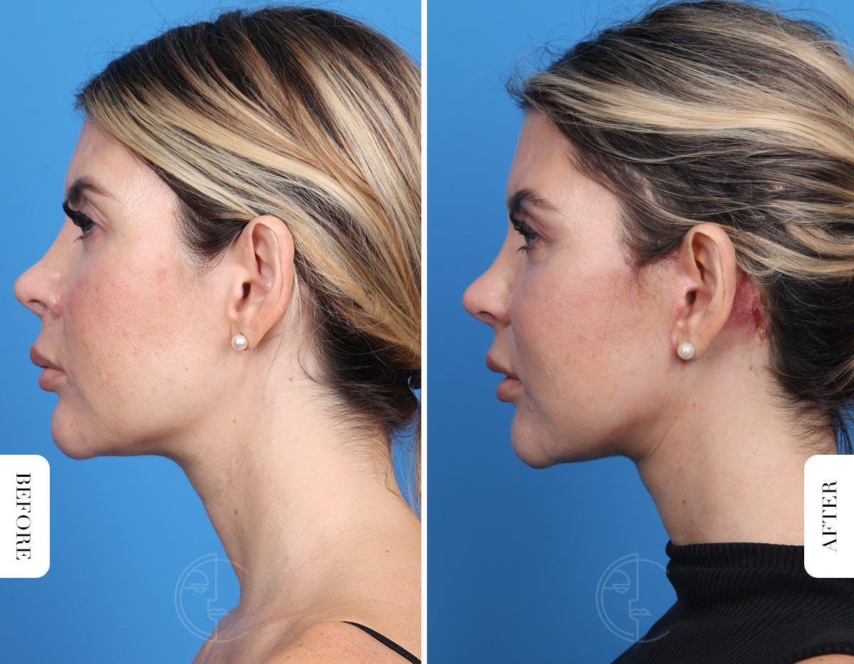Miami Facelift/Neck Lift Before & After Gallery - Patient 294573 - Image 6 - The Chopra Plastic Surgery Center