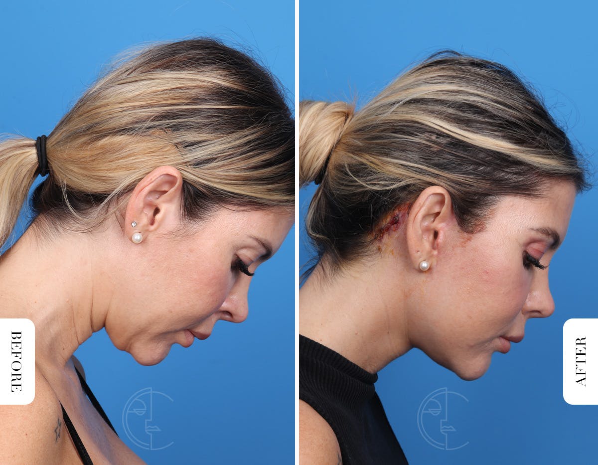 Miami Facelift/Neck Lift Before & After Gallery - Patient 294573 - Image 4 - The Chopra Plastic Surgery Center