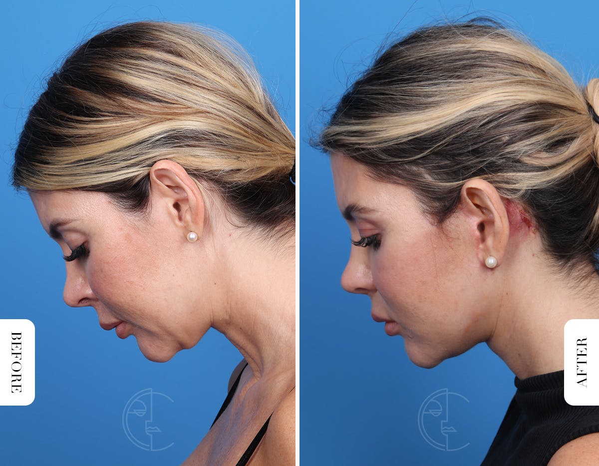 Miami Facelift/Neck Lift Before & After Gallery - Patient 294573 - Image 7 - The Chopra Plastic Surgery Center
