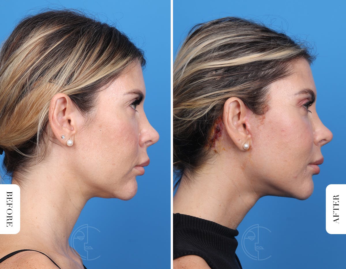 Miami Facelift/Neck Lift Before & After Gallery - Patient 294573 - Image 3 - The Chopra Plastic Surgery Center