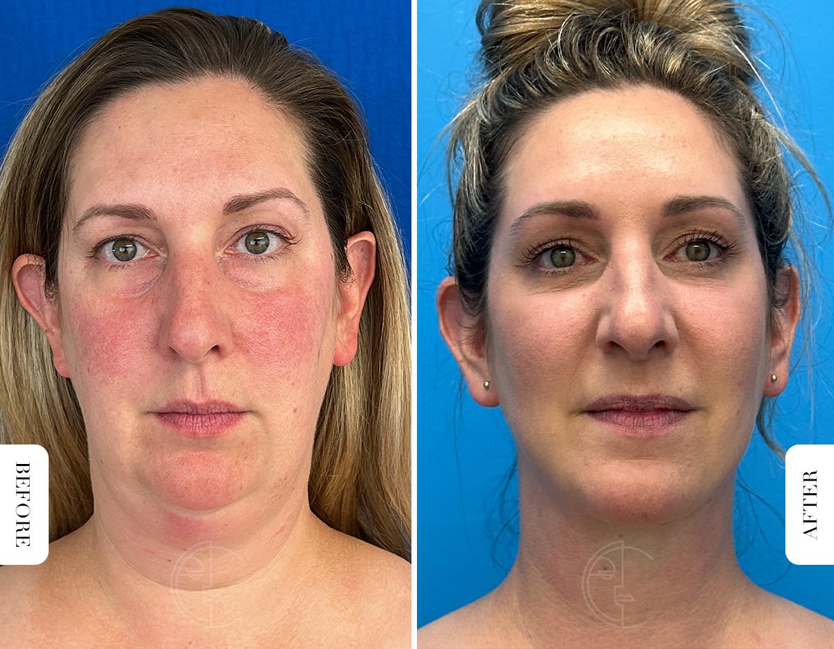 Miami Lower Eyelid Lift Before & After Gallery - Patient 804869 - Image 1 - The Chopra Plastic Surgery Center